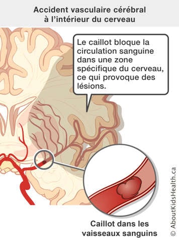 Un caillot dans un vaisseau sanguin bloque la circulation sanguine dans une zone spécifique du cerveau, ce qui provoque des lésions