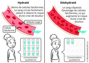 Lorsque l'on est déshydraté, le sang s'épaissit et il y a plus de drépanocytes, augmentant le risque d'une crise de douleur