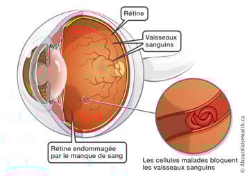 Rétine endommagée par un manque de sang dû à des cellules malades bloquant les vaisseaux sanguins de la rétine