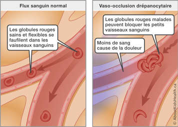 Globules rouges malades bloquent les petits vaisseaux sanguin, et moins de sang dans ces vaisseaux cause de la douleur